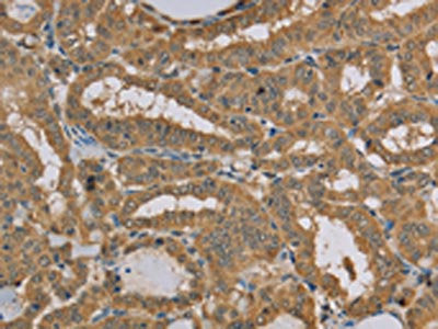 The image on the left is immunohistochemistry of paraffin-embedded Human thyroid cancer tissue using the antibody Antibody) at dilution 1/20, on the right is treated with fusion protein. (Original magnification: ×200)Rabbit anti-Human MVK Polyclonal Antibody