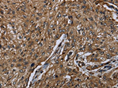 The image on the left is immunohistochemistry of paraffin-embedded Human esophagus cancer tissue using HACL1 Antibody(HACL1 Antibody) at dilution 1/20, on the right is treated with fusion protein. (Original magnification: ×200)Rabbit anti-Human HACL1 Polyclonal Antibody
