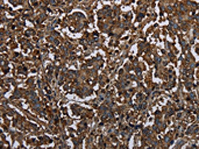 The image on the left is immunohistochemistry of paraffin-embedded Human liver cancer tissue using the antibody Antibody) at dilution 1/20, on the right is treated with fusion protein. (Original magnification: ×200)Rabbit anti-Human HACL1 Polyclonal Antibody