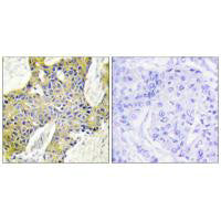 Immunohistochemistry analysis of paraffin-embedded human breast carcinoma tissue using IARS2 antibody.Rabbit anti-Human IARS2 Polyclonal Antibody