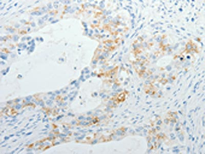 The image on the left is immunohistochemistry of paraffin-embedded Human cervical cancer tissue using TNFRSF1B Antibody(TNFRSF1B Antibody) at dilution 1/5, on the right is treated with fusion protein. (Original magnification: ×200)Rabbit anti-Human TNFRSF1B Polyclonal Antibody