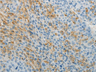 The image on the left is immunohistochemistry of paraffin-embedded Human liver cancer tissue using the antibody Antibody) at dilution 1/5, on the right is treated with fusion protein. (Original magnification: ×200)Rabbit anti-Human TNFRSF1B Polyclonal Antibody