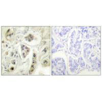Immunohistochemical analysis of paraffin-embedded human lung carcinoma tissue using HSP60 antibody.Rabbit anti-Human HSPD1 Polyclonal Antibody