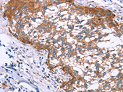 The image on the left is immunohistochemistry of paraffin-embedded Human cervical cancer tissue using APAF1 Antibody(APAF1 Antibody) at dilution 1/20, on the right is treated with synthetic peptide. (Original magnification: ×200)Rabbit anti-Human APAF1 Polyclonal Antibody
