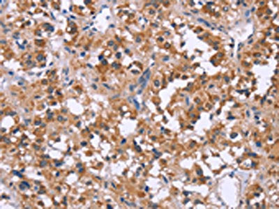 The image on the left is immunohistochemistry of paraffin-embedded Human thyroid cancer tissue using the antibody Antibody) at dilution 1/20, on the right is treated with synthetic peptide. (Original magnification: ×200)Rabbit anti-Human APAF1 Polyclonal Antibody