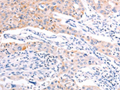 The image on the left is immunohistochemistry of paraffin-embedded Human lung cancer tissue using RALA Antibody(RalA Antibody) at dilution 1/20, on the right is treated with synthetic peptide. (Original magnification: ×200)Rabbit anti-Human RALA Polyclonal Antibody