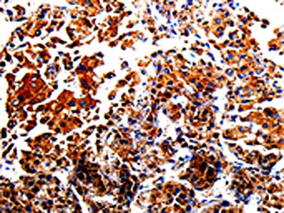 The image is immunohistochemistry of paraffin-embedded Human liver cancer tissue using AFP Antibody(AFP Antibody) at dilution 1/40. (Original magnification: X200)Rabbit anti-Human AFP Polyclonal Antibody