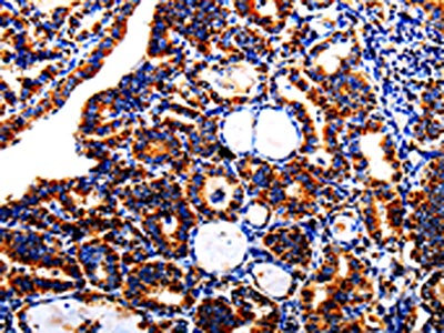 The image is immunohistochemistry of paraffin-embedded Human thyroid cancer tissue using the antibody Antibody) at dilution 1/40. (Original magnification: X200)