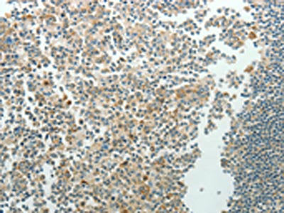 The image on the left is immunohistochemistry of paraffin-embedded Human tonsil tissue using the antibody Antibody) at dilution 1/70, on the right is treated with synthetic peptide. (Original magnification: ×200)Rabbit anti-Human NDRG3 Polyclonal Antibody