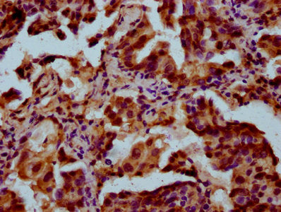 IHC image of POU5F1B Antibody diluted at 1:300 and staining in paraffin-embedded human lung cancer performed on a Leica BondTM system. After dewaxing and hydration, antigen retrieval was mediated by high pressure in a citrate buffer (pH 6.0). Section was blocked with 10% normal goat serum 30min at RT. Then primary antibody (1% BSA) was incubated at 4°C overnight. The primary is detected by a biotinylated secondary antibody and visualized using an HRP conjugated SP system.