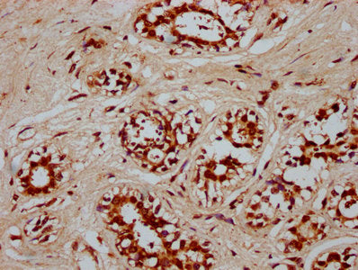 IHC image of POU5F1B Antibody diluted at 1:300 and staining in paraffin-embedded human breast cancer performed on a Leica BondTM system. After dewaxing and hydration, antigen retrieval was mediated by high pressure in a citrate buffer (pH 6.0). Section was blocked with 10% normal goat serum 30min at RT. Then primary antibody (1% BSA) was incubated at 4°C overnight. The primary is detected by a biotinylated secondary antibody and visualized using an HRP conjugated SP system.