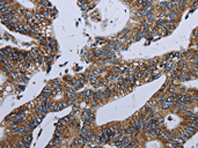 The image on the left is immunohistochemistry of paraffin-embedded Human colon cancer tissue using NDUFA13 Antibody(NDUFA13 Antibody) at dilution 1/40, on the right is treated with fusion protein. (Original magnification: ×200)Rabbit anti-Human NDUFA13 Polyclonal Antibody
