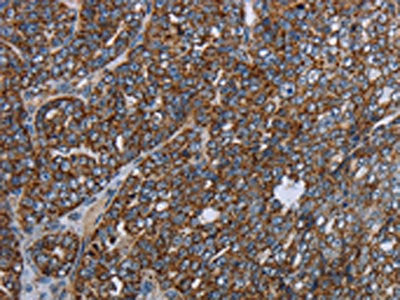 The image on the left is immunohistochemistry of paraffin-embedded Human ovarian cancer tissue using the antibody Antibody) at dilution 1/40, on the right is treated with fusion protein. (Original magnification: ×200)Rabbit anti-Human NDUFA13 Polyclonal Antibody