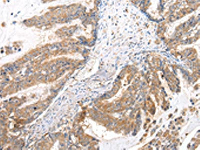 The image on the left is immunohistochemistry of paraffin-embedded Human esophagus cancer tissue using XKRX Antibody(XKRX Antibody) at dilution 1/25, on the right is treated with synthetic peptide. (Original magnification: ×200)Rabbit anti-Human XKRX Polyclonal Antibody