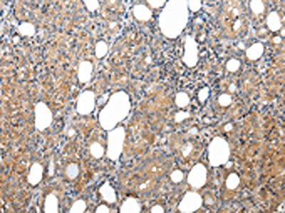 The image on the left is immunohistochemistry of paraffin-embedded Human thyroid cancer tissue using the antibody Antibody) at dilution 1/25, on the right is treated with synthetic peptide. (Original magnification: ×200)Rabbit anti-Human XKRX Polyclonal Antibody
