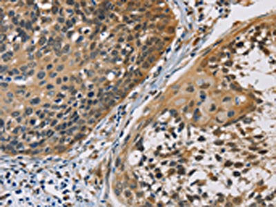 The image on the left is immunohistochemistry of paraffin-embedded Human cervical cancer tissue using the antibody Antibody) at dilution 1/40, on the right is treated with fusion protein. (Original magnification: ×200)