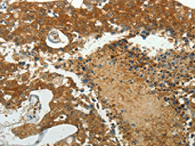 The image on the left is immunohistochemistry of paraffin-embedded Human breast cancer tissue using MCM4 Antibody(MCM4 Antibody) at dilution 1/40, on the right is treated with synthetic peptide. (Original magnification: ×200)