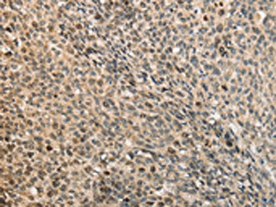 The image on the left is immunohistochemistry of paraffin-embedded Human lung cancer tissue using CDCA8 Antibody(CDCA8 Antibody) at dilution 1/40, on the right is treated with fusion protein. (Original magnification: ×200)Rabbit anti-Human CDCA8 Polyclonal Antibody