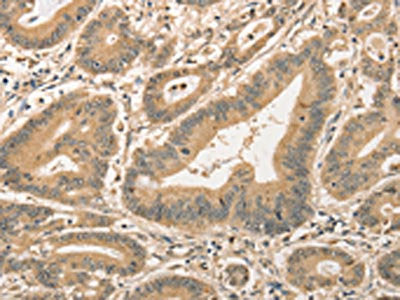 The image on the left is immunohistochemistry of paraffin-embedded Human colon cancer tissue using the antibody Antibody) at dilution 1/40, on the right is treated with fusion protein. (Original magnification: ×200)Rabbit anti-Human CDCA8 Polyclonal Antibody