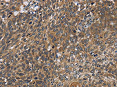 The image on the left is immunohistochemistry of paraffin-embedded Human cervical cancer tissue using CYB5A Antibody(CYB5A Antibody) at dilution 1/40, on the right is treated with fusion protein. (Original magnification: ×200)Rabbit anti-Human CYB5A Polyclonal Antibody