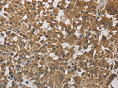 The image on the left is immunohistochemistry of paraffin-embedded Human thyroid cancer tissue using the antibody Antibody) at dilution 1/40, on the right is treated with fusion protein. (Original magnification: ×200)Rabbit anti-Human CYB5A Polyclonal Antibody