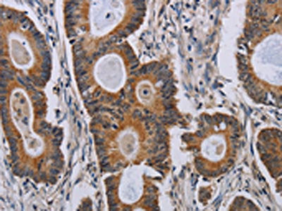 The image on the left is immunohistochemistry of paraffin-embedded Human colon cancer tissue using the antibody Antibody) at dilution 1/40, on the right is treated with synthetic peptide. (Original magnification: ×200)Rabbit anti-Human PARP8 Polyclonal Antibody