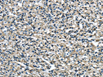 The image on the left is immunohistochemistry of paraffin-embedded Human prostate cancer tissue using ERP44 Antibody(ERP44 Antibody) at dilution 1/30, on the right is treated with fusion protein. (Original magnification: ×200)Rabbit anti-Human ERP44 Polyclonal Antibody