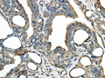 The image on the left is immunohistochemistry of paraffin-embedded Human thyroid cancer tissue using the antibody Antibody) at dilution 1/30, on the right is treated with fusion protein. (Original magnification: ×200)Rabbit anti-Human ERP44 Polyclonal Antibody