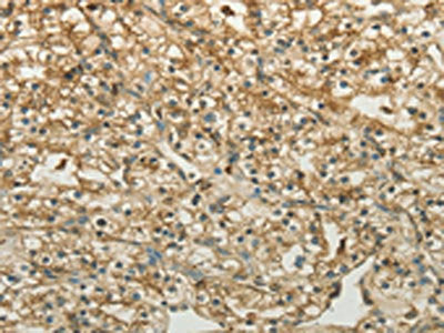 The image on the left is immunohistochemistry of paraffin-embedded Human renal cancer tissue using CTSV Antibody(CTSV Antibody) at dilution 1/50, on the right is treated with fusion protein. (Original magnification: ×200)Rabbit anti-Human CTSV Polyclonal Antibody