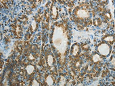 The image on the left is immunohistochemistry of paraffin-embedded Human thyroid cancer tissue using the antibody Antibody) at dilution 1/50, on the right is treated with fusion protein. (Original magnification: ×200)Rabbit anti-Human CTSV Polyclonal Antibody