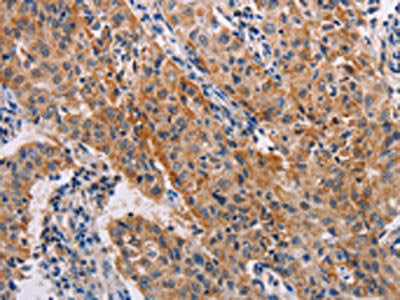The image on the left is immunohistochemistry of paraffin-embedded Human lung cancer tissue using ADH1A Antibody(ADH1A Antibody) at dilution 1/20, on the right is treated with fusion protein. (Original magnification: ×200)Rabbit anti-Human ADH1A Polyclonal Antibody
