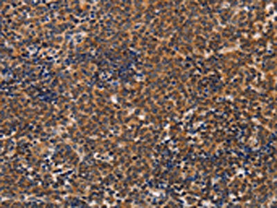 The image on the left is immunohistochemistry of paraffin-embedded Human lymphoma tissue using the antibody Antibody) at dilution 1/20, on the right is treated with fusion protein. (Original magnification: ×200)