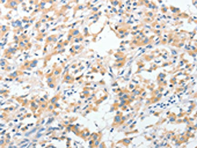 The image on the left is immunohistochemistry of paraffin-embedded Human thyroid cancer tissue using RPN1 Antibody(RPN1 Antibody) at dilution 1/30, on the right is treated with fusion protein. (Original magnification: ×200)Rabbit anti-Human RPN1 Polyclonal Antibody