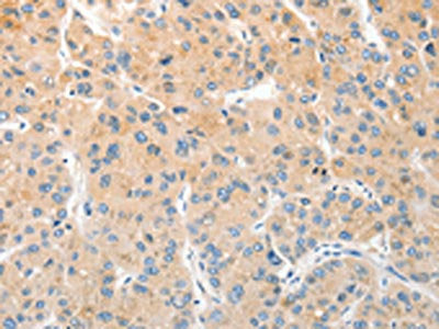 The image on the left is immunohistochemistry of paraffin-embedded Human liver cancer tissue using the antibody Antibody) at dilution 1/30, on the right is treated with fusion protein. (Original magnification: ×200)Rabbit anti-Human RPN1 Polyclonal Antibody