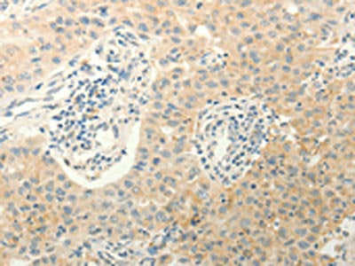 The image on the left is immunohistochemistry of paraffin-embedded Human lung cancer tissue using ERG Antibody(ERG Antibody) at dilution 1/40, on the right is treated with fusion protein. (Original magnification: ×200)Rabbit anti-Human ERG Polyclonal Antibody