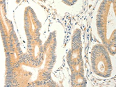 The image on the left is immunohistochemistry of paraffin-embedded Human colon cancer tissue using the antibody Antibody) at dilution 1/40, on the right is treated with fusion protein. (Original magnification: ×200)Rabbit anti-Human ERG Polyclonal Antibody