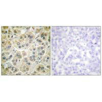 Immunohistochemistry analysis of paraffin-embedded human colon carcinoma tissue using Vimentin antibody.Rabbit anti-Human VIM Polyclonal Antibody