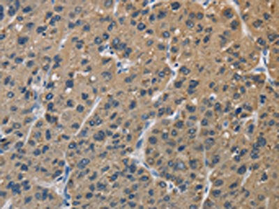 The image is immunohistochemistry of paraffin-embedded Human liver cancer tissue using SIGMAR1 Antibody(SIGMAR1 Antibody) at dilution 1/50. (Original magnification: ×200)Rabbit anti-Human SIGMAR1 Polyclonal Antibody