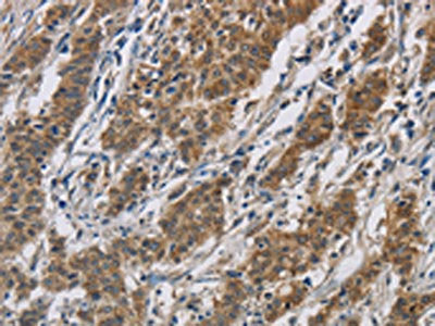 The image is immunohistochemistry of paraffin-embedded Human gastic cancer tissue using the antibody Antibody) at dilution 1/50. (Original magnification: ×200)Rabbit anti-Human SIGMAR1 Polyclonal Antibody