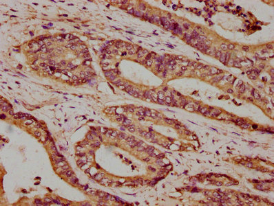 IHC image of ATP2B4 Antibody diluted at 1:100 and staining in paraffin-embedded human colon cancer performed on a Leica BondTM system. After dewaxing and hydration, antigen retrieval was mediated by high pressure in a citrate buffer (pH 6.0). Section was blocked with 10% normal goat serum 30min at RT. Then primary antibody (1% BSA) was incubated at 4°C overnight. The primary is detected by a biotinylated secondary antibody and visualized using an HRP conjugated SP system.