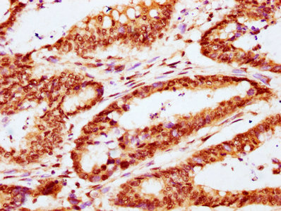 IHC image of CABIN1 Antibody diluted at 1:400 and staining in paraffin-embedded human colon cancer performed on a Leica BondTM system. After dewaxing and hydration, antigen retrieval was mediated by high pressure in a citrate buffer (pH 6.0). Section was blocked with 10% normal goat serum 30min at RT. Then primary antibody (1% BSA) was incubated at 4°C overnight. The primary is detected by a biotinylated secondary antibody and visualized using an HRP conjugated SP system.