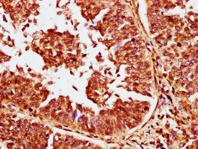 IHC image of CABIN1 Antibody diluted at 1:400 and staining in paraffin-embedded human cervical cancer performed on a Leica BondTM system. After dewaxing and hydration, antigen retrieval was mediated by high pressure in a citrate buffer (pH 6.0). Section was blocked with 10% normal goat serum 30min at RT. Then primary antibody (1% BSA) was incubated at 4°C overnight. The primary is detected by a biotinylated secondary antibody and visualized using an HRP conjugated SP system.