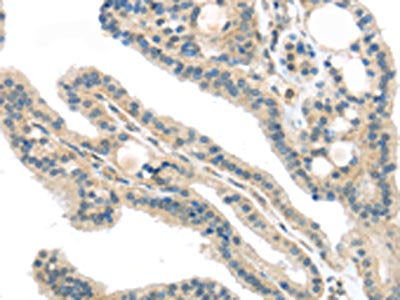 The image on the left is immunohistochemistry of paraffin-embedded Human thyroid cancer tissue using VPS26A Antibody(VPS26A Antibody) at dilution 1/40, on the right is treated with synthetic peptide. (Original magnification: ×200)Rabbit anti-Human VPS26A Polyclonal Antibody