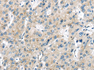 The image on the left is immunohistochemistry of paraffin-embedded Human liver cancer tissue using the antibody Antibody) at dilution 1/40, on the right is treated with synthetic peptide. (Original magnification: ×200)Rabbit anti-Human VPS26A Polyclonal Antibody