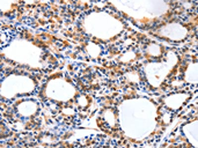 The image on the left is immunohistochemistry of paraffin-embedded Human thyroid cancer tissue using YWHAQ Antibody(YWHAQ Antibody) at dilution 1/20, on the right is treated with synthetic peptide. (Original magnification: ×200)Rabbit anti-Human YWHAQ Polyclonal Antibody