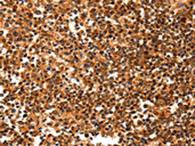 The image on the left is immunohistochemistry of paraffin-embedded Human tonsil tissue using the antibody Antibody) at dilution 1/20, on the right is treated with synthetic peptide. (Original magnification: ×200)Rabbit anti-Human YWHAQ Polyclonal Antibody