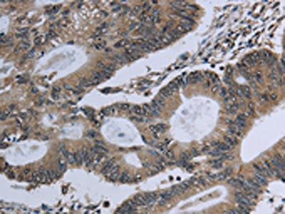 The image on the left is immunohistochemistry of paraffin-embedded Human colon cancer tissue using GNG2 Antibody(GNG2 Antibody) at dilution 1/60, on the right is treated with fusion protein. (Original magnification: ×200)Rabbit anti-Human GNG2 Polyclonal Antibody