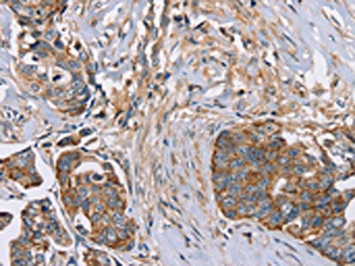 The image on the left is immunohistochemistry of paraffin-embedded Human cervical cancer tissue using FAIM2 Antibody(FAIM2 Antibody) at dilution 1/30, on the right is treated with fusion protein. (Original magnification: ×200)Rabbit anti-Human FAIM2 Polyclonal Antibody
