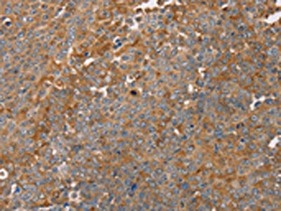 The image on the left is immunohistochemistry of paraffin-embedded Human ovarian cancer tissue using the antibody Antibody) at dilution 1/30, on the right is treated with fusion protein. (Original magnification: ×200)Rabbit anti-Human FAIM2 Polyclonal Antibody