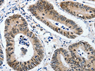 The image on the left is immunohistochemistry of paraffin-embedded Human colon cancer tissue using KLF5 Antibody(KLF5 Antibody) at dilution 1/120, on the right is treated with synthetic peptide. (Original magnification: ×200)